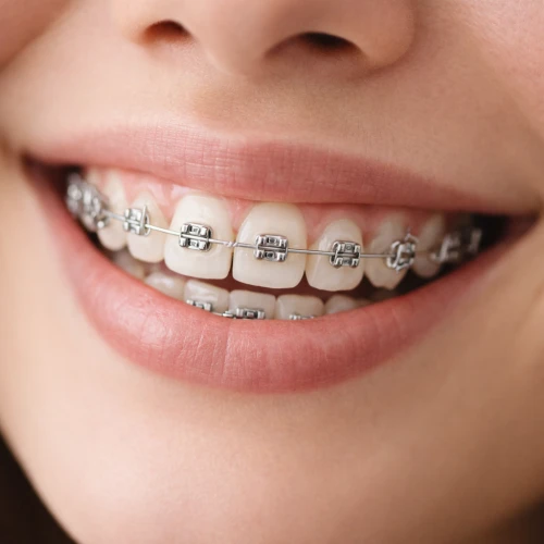 Appareil dentaire et hygiène : conseils pratiques pour éviter les blessures et irritations 